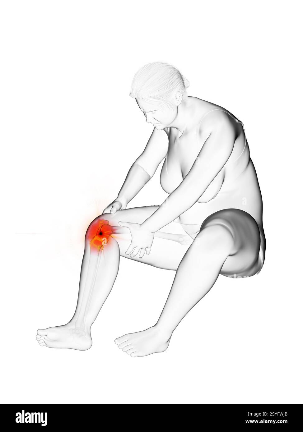 Femme en surpoids avec articulation du genou douloureuse, illustration. Banque D'Images