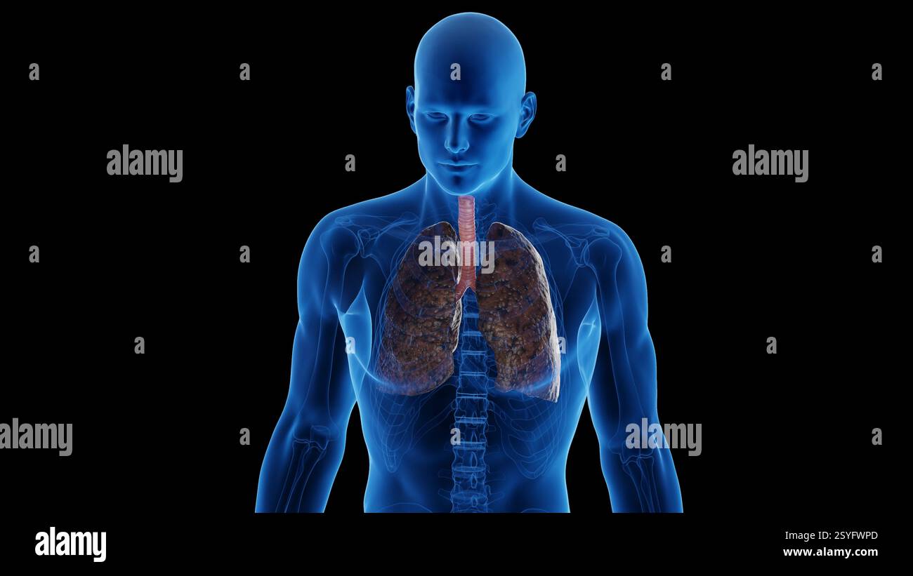 Poumons du fumeur, illustration. Banque D'Images