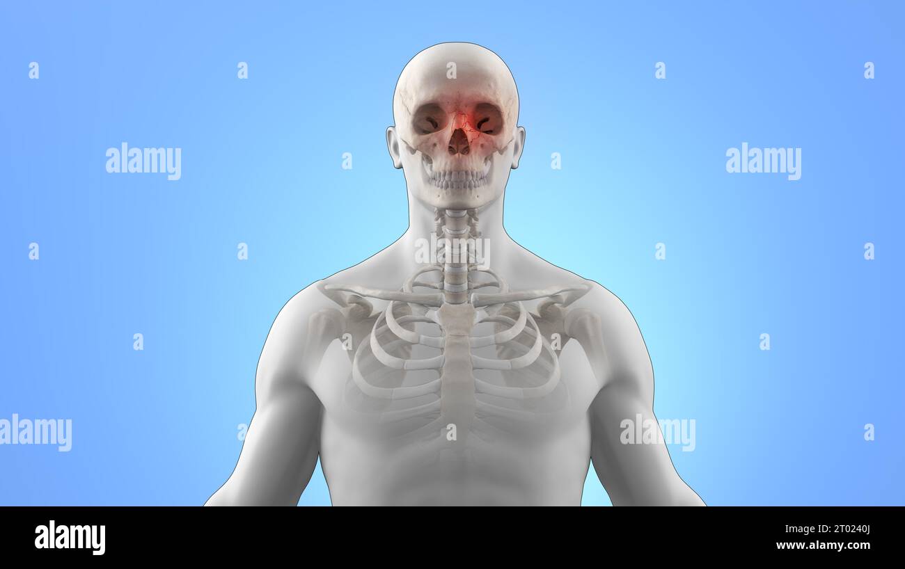 Illustration médicale 3D de fracture du nez crânien sur squelette humain Banque D'Images