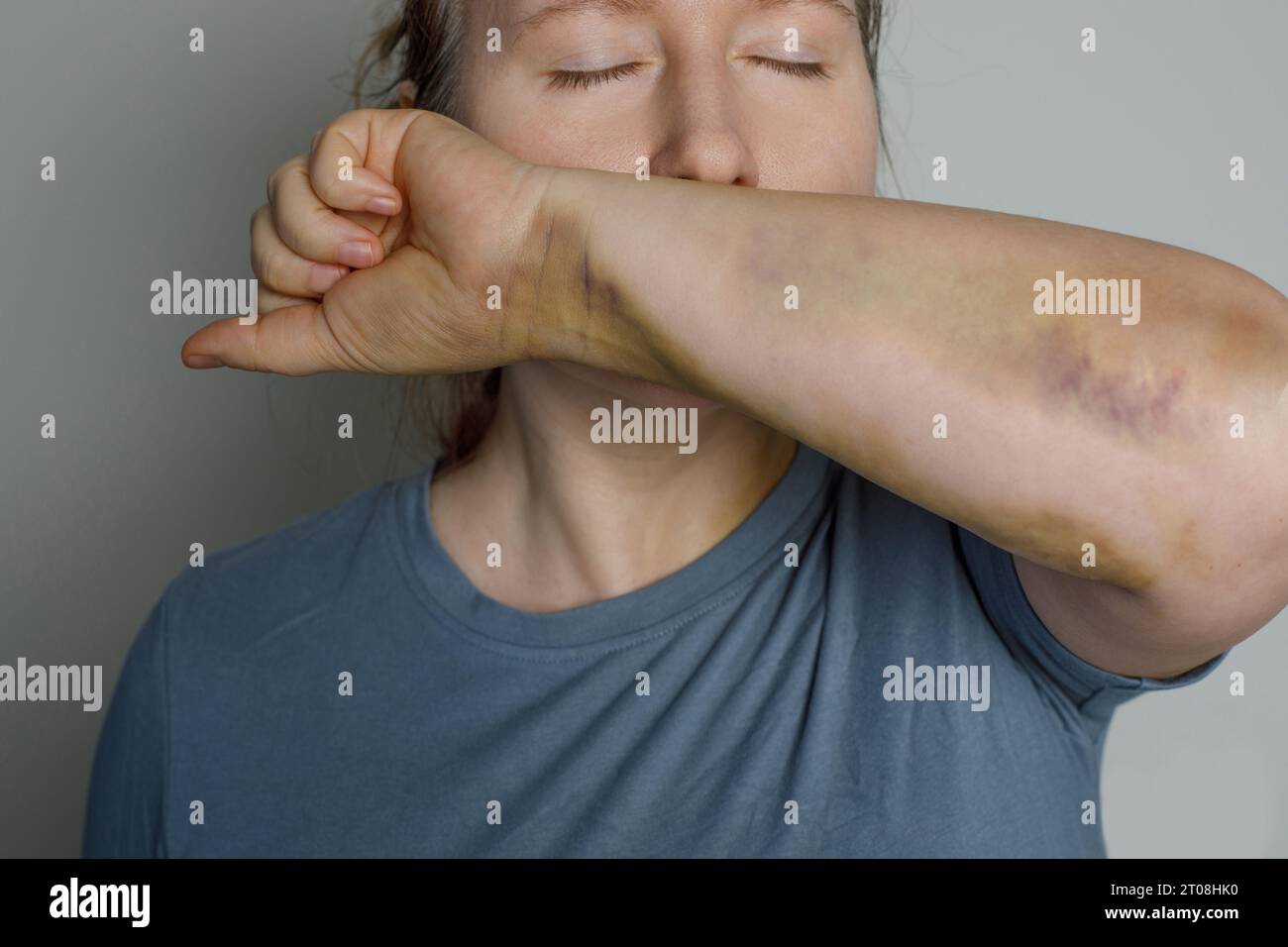 Jolie jeune femme avec ecchymose de blessure sur sa main, portrait en gros plan. Banque D'Images