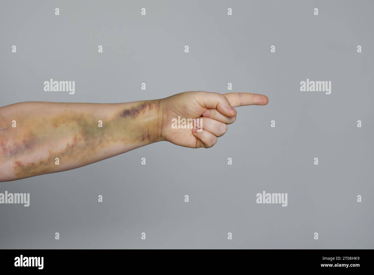 Main féminine avec des problèmes ecchymose pointant vers l'agresseur, blâmant et accusant. Violence domestique et abus contre les femmes concept de problème social. Banque D'Images