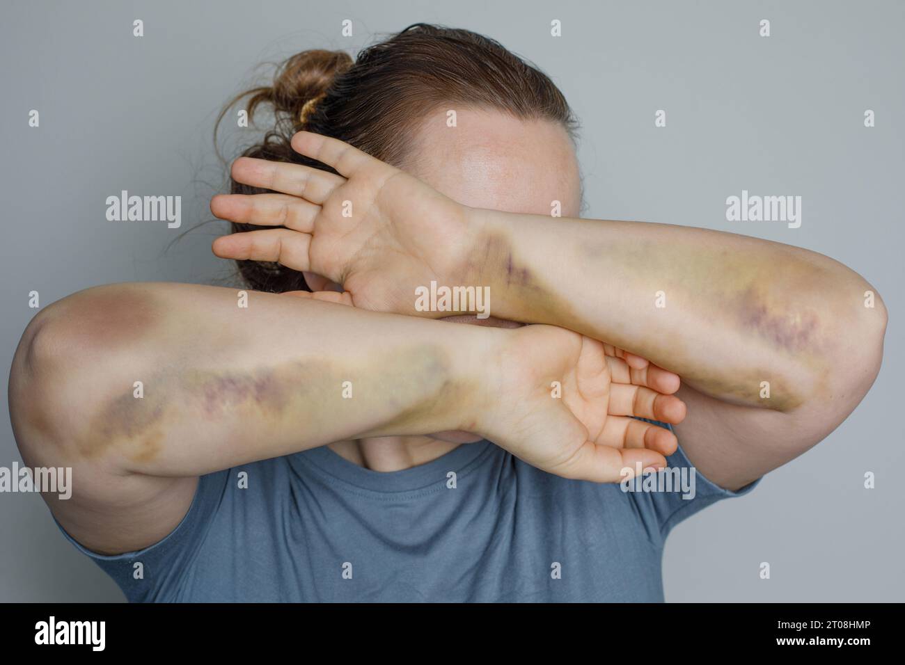 Portrait de femme d'expression dépressive cachant son visage ses mains avec des problèmes ecchymose. Violence domestique et abus contre les femmes Banque D'Images