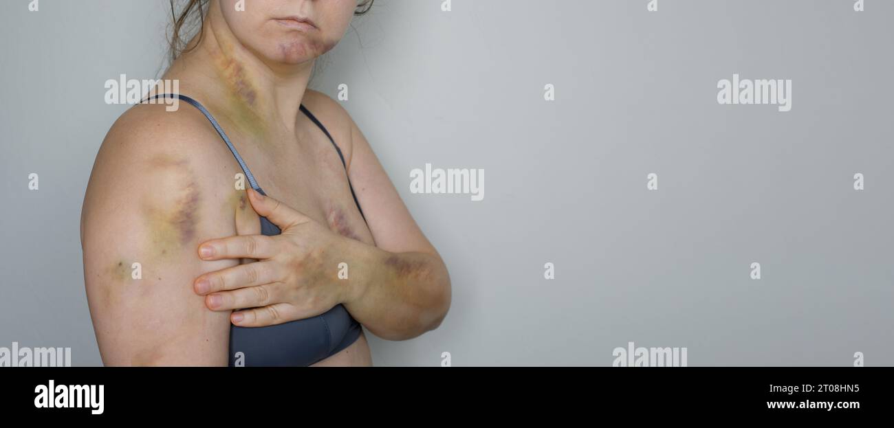La vie fait mal. Femme atteinte d'ecchymoses. Stop violence et concept de cicatrice d'accident de voiture Banque D'Images