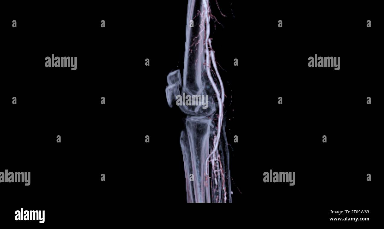 Analyse de l'artère fémorale TDM à partir de l'image de l'artère fémorale pour diagnostic de maladie artérielle périphérique aiguë ou chronique. Banque D'Images