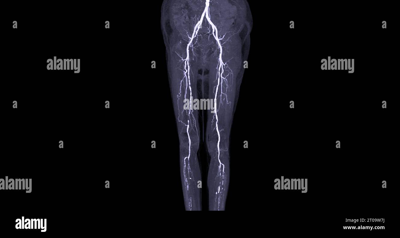 Analyse de l'artère fémorale TDM à partir de l'image de l'artère fémorale pour diagnostic de maladie artérielle périphérique aiguë ou chronique. Banque D'Images