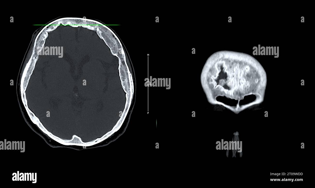 Acquisition CT de la vue sagittale du cerveau pour le diagnostic des tumeurs cérébrales, des maladies cérébrales et des maladies vasculaires. Banque D'Images