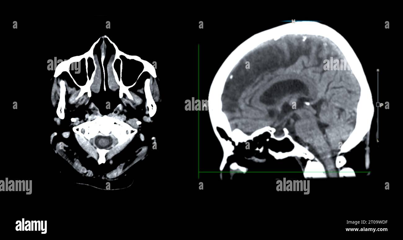 Acquisition CT de la vue sagittale du cerveau pour le diagnostic des tumeurs cérébrales, des maladies cérébrales et des maladies vasculaires. Banque D'Images