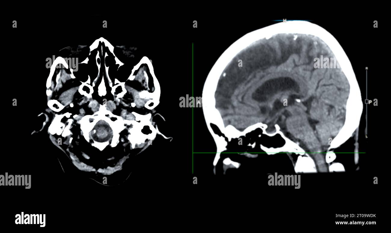 Acquisition CT de la vue sagittale du cerveau pour le diagnostic des tumeurs cérébrales, des maladies cérébrales et des maladies vasculaires. Banque D'Images