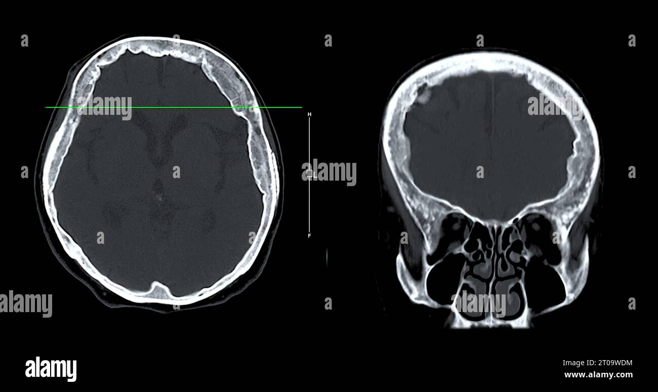 Acquisition CT de la vue sagittale du cerveau pour le diagnostic des tumeurs cérébrales, des maladies cérébrales et des maladies vasculaires. Banque D'Images