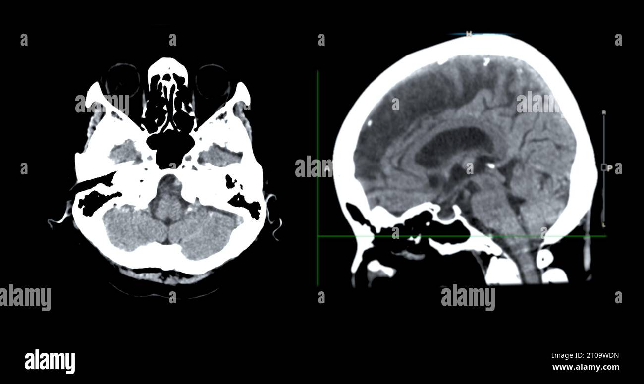 Acquisition CT de la vue sagittale du cerveau pour le diagnostic des tumeurs cérébrales, des maladies cérébrales et des maladies vasculaires. Banque D'Images