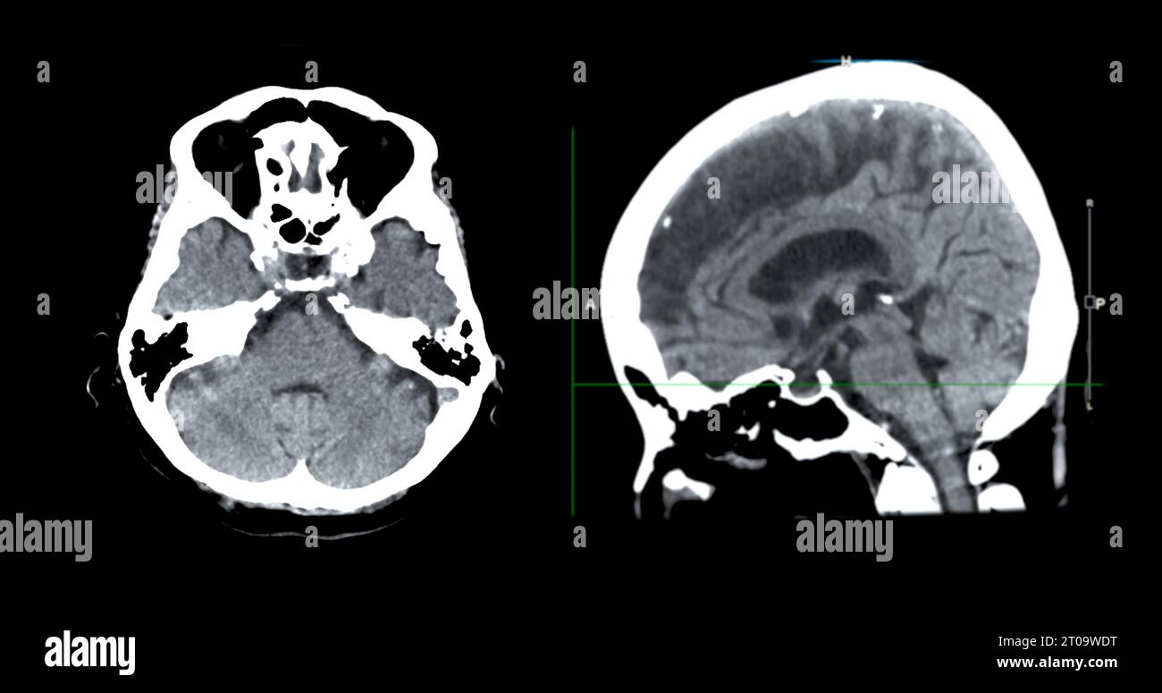 Acquisition CT de la vue sagittale du cerveau pour le diagnostic des tumeurs cérébrales, des maladies cérébrales et des maladies vasculaires. Banque D'Images