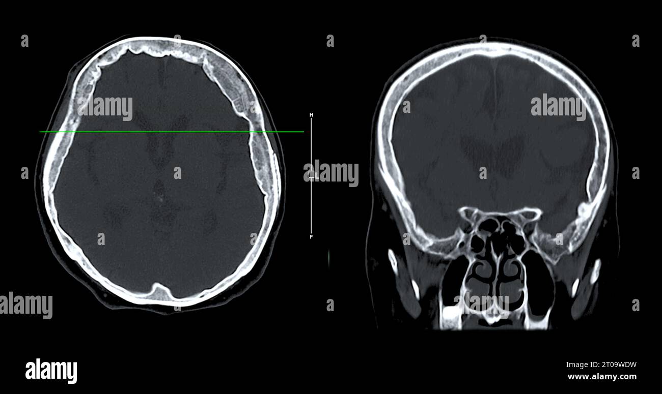 Acquisition CT de la vue sagittale du cerveau pour le diagnostic des tumeurs cérébrales, des maladies cérébrales et des maladies vasculaires. Banque D'Images