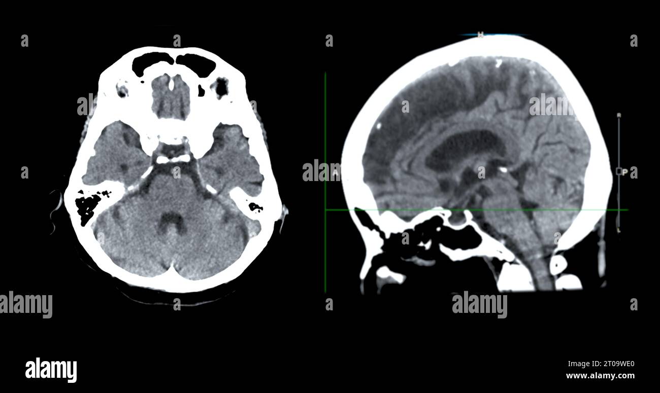 Acquisition CT de la vue sagittale du cerveau pour le diagnostic des tumeurs cérébrales, des maladies cérébrales et des maladies vasculaires. Banque D'Images