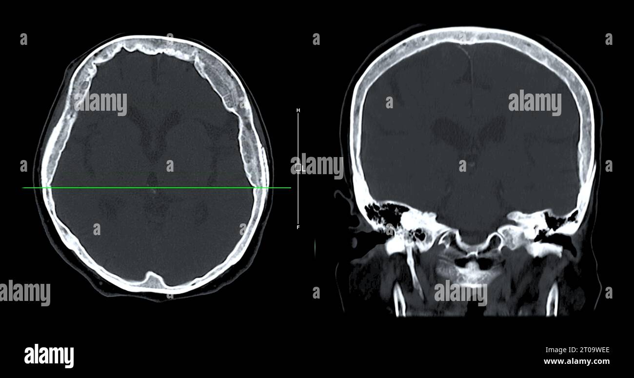 Acquisition CT de la vue sagittale du cerveau pour le diagnostic des tumeurs cérébrales, des maladies cérébrales et des maladies vasculaires. Banque D'Images
