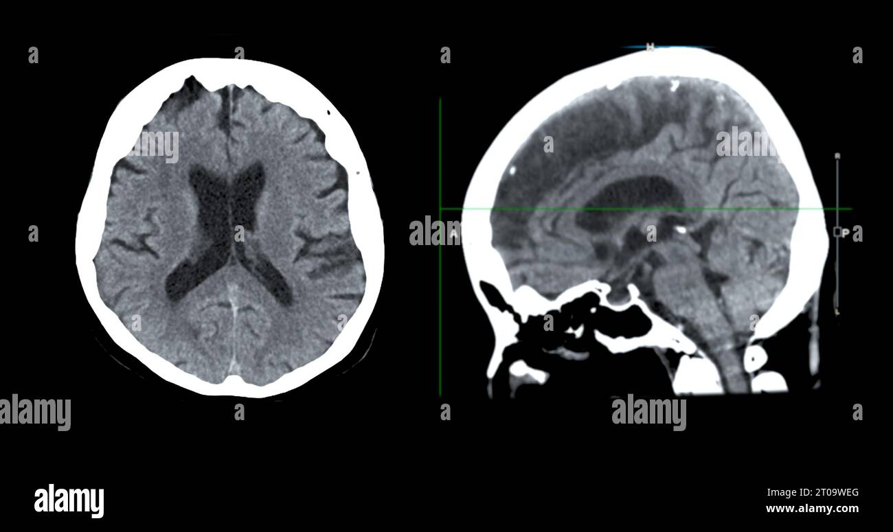 Acquisition CT de la vue sagittale du cerveau pour le diagnostic des tumeurs cérébrales, des maladies cérébrales et des maladies vasculaires. Banque D'Images