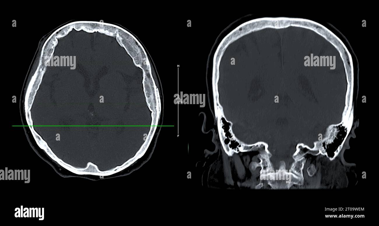 Acquisition CT de la vue sagittale du cerveau pour le diagnostic des tumeurs cérébrales, des maladies cérébrales et des maladies vasculaires. Banque D'Images