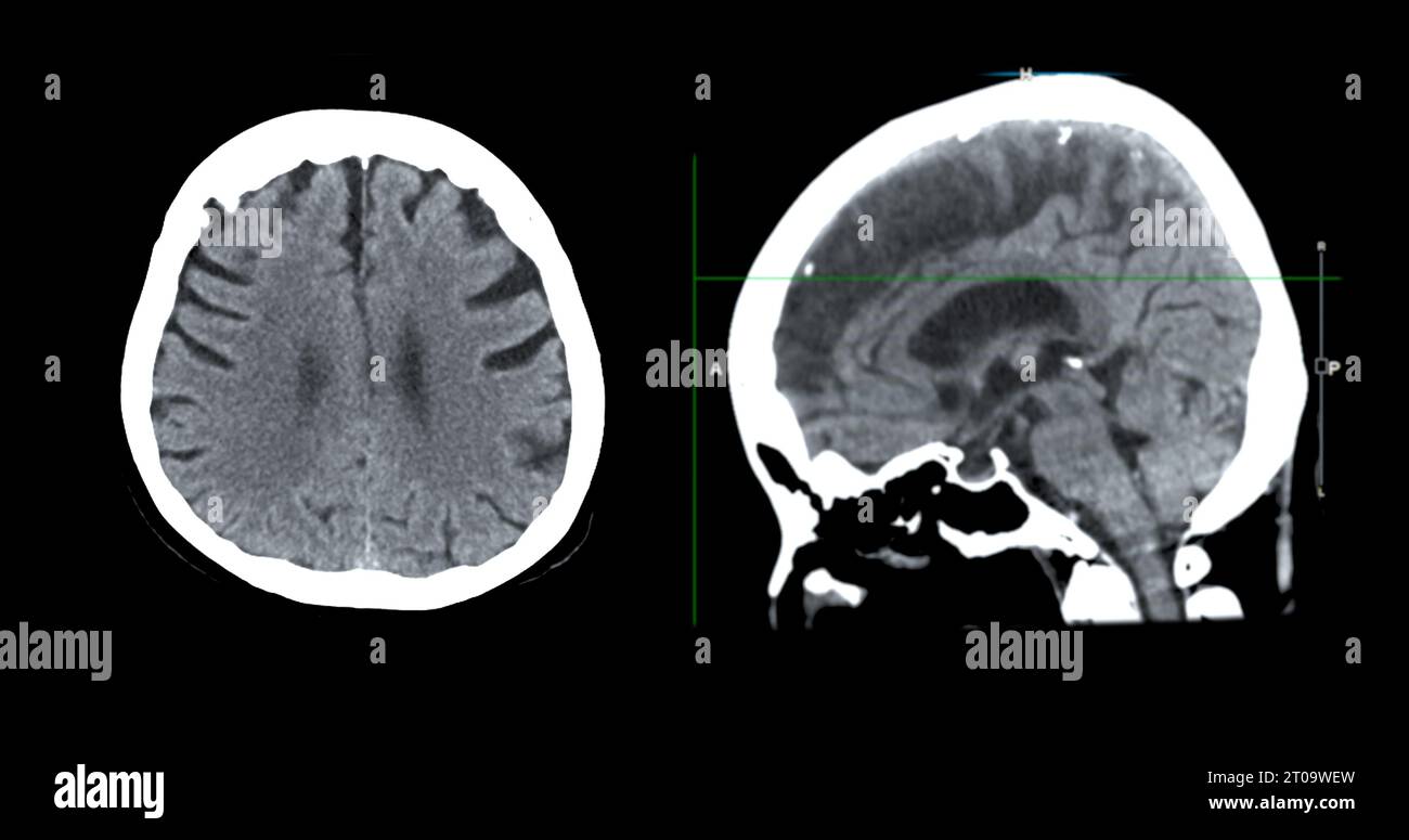 Acquisition CT de la vue sagittale du cerveau pour le diagnostic des tumeurs cérébrales, des maladies cérébrales et des maladies vasculaires. Banque D'Images