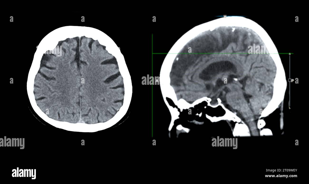 Acquisition CT de la vue sagittale du cerveau pour le diagnostic des tumeurs cérébrales, des maladies cérébrales et des maladies vasculaires. Banque D'Images
