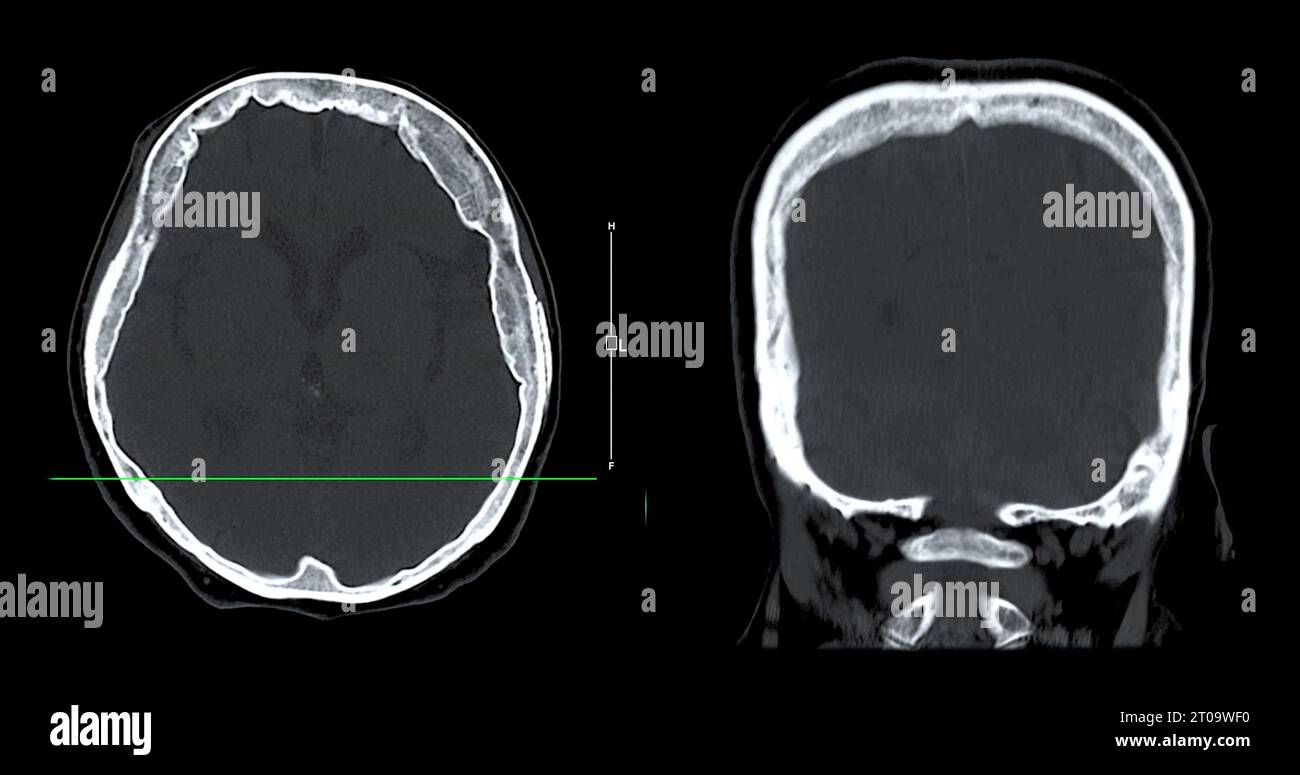 Acquisition CT de la vue sagittale du cerveau pour le diagnostic des tumeurs cérébrales, des maladies cérébrales et des maladies vasculaires. Banque D'Images