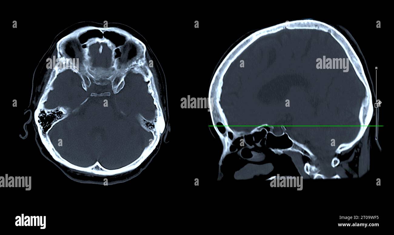 Acquisition CT de la vue sagittale du cerveau pour le diagnostic des tumeurs cérébrales, des maladies cérébrales et des maladies vasculaires. Banque D'Images