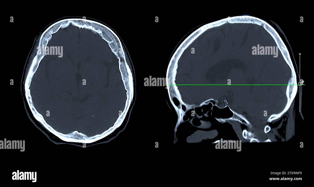 Acquisition CT de la vue sagittale du cerveau pour le diagnostic des tumeurs cérébrales, des maladies cérébrales et des maladies vasculaires. Banque D'Images