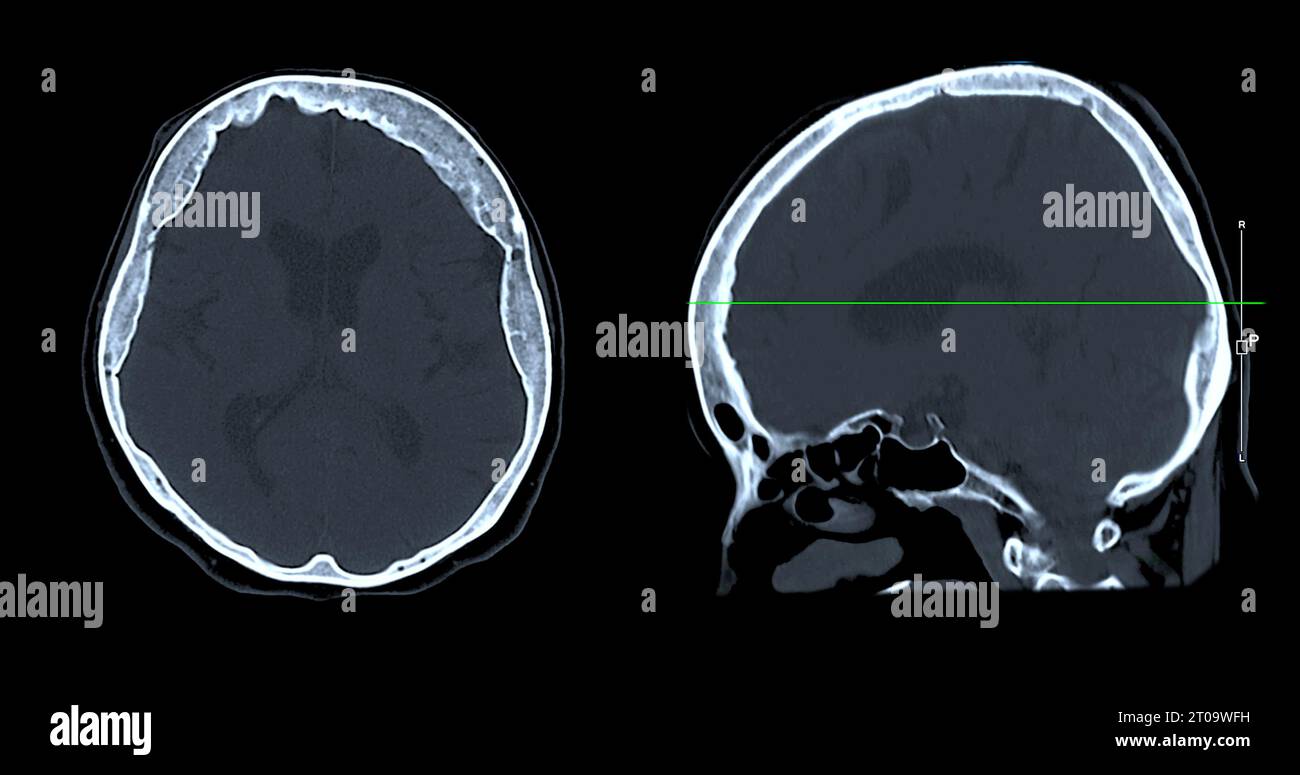 Acquisition CT de la vue sagittale du cerveau pour le diagnostic des tumeurs cérébrales, des maladies cérébrales et des maladies vasculaires. Banque D'Images