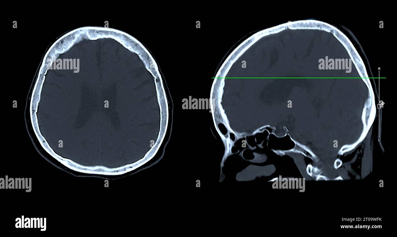 Acquisition CT de la vue sagittale du cerveau pour le diagnostic des tumeurs cérébrales, des maladies cérébrales et des maladies vasculaires. Banque D'Images