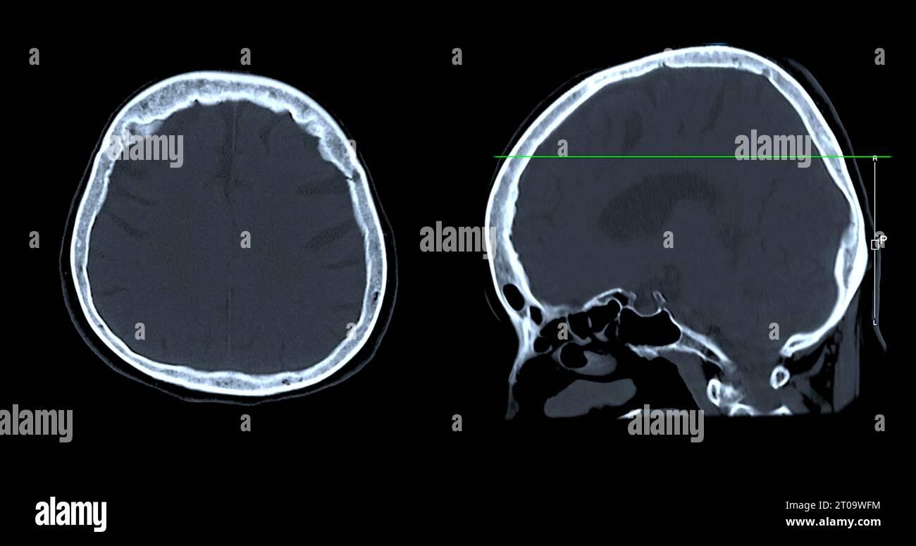 Acquisition CT de la vue sagittale du cerveau pour le diagnostic des tumeurs cérébrales, des maladies cérébrales et des maladies vasculaires. Banque D'Images