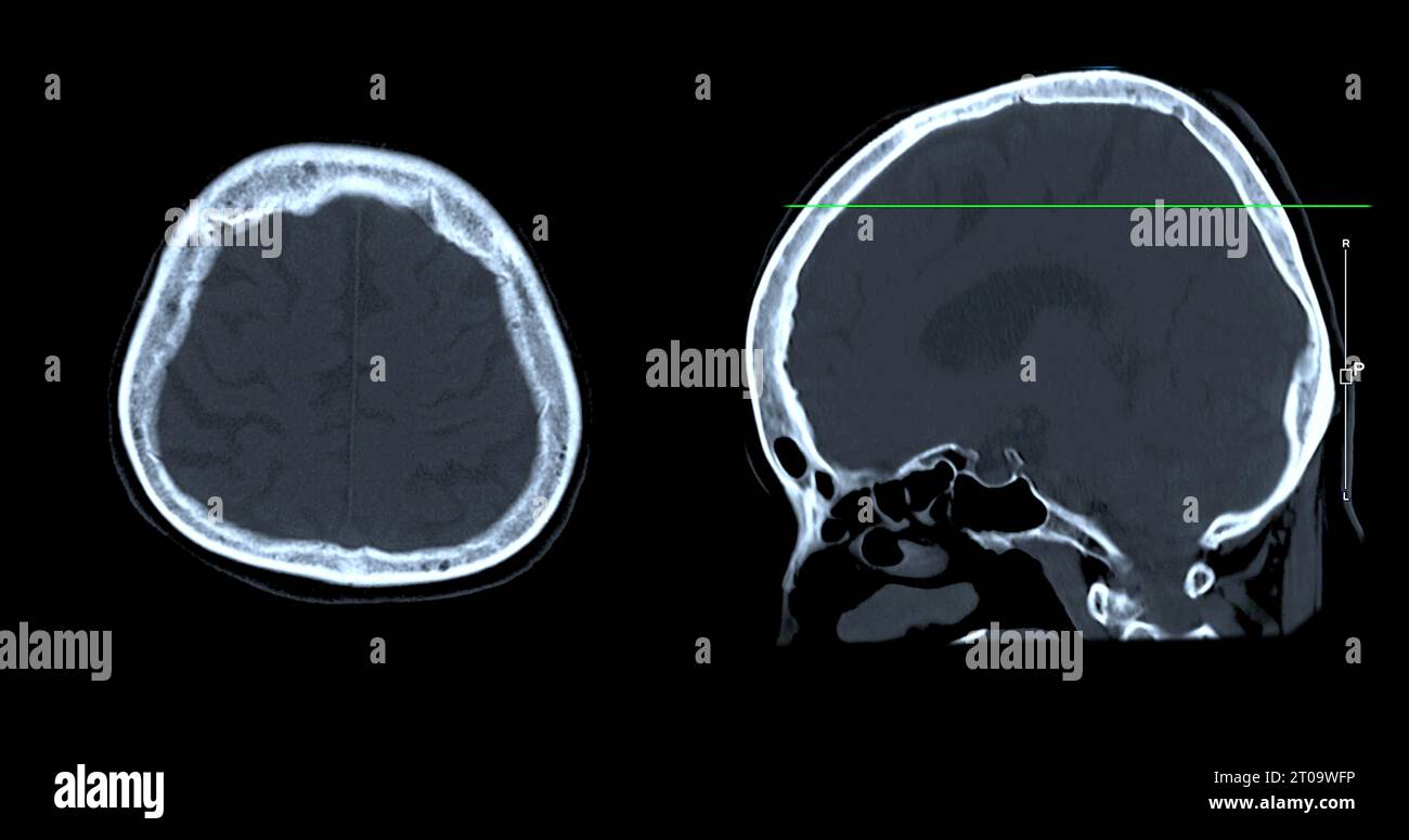 Acquisition CT de la vue sagittale du cerveau pour le diagnostic des tumeurs cérébrales, des maladies cérébrales et des maladies vasculaires. Banque D'Images