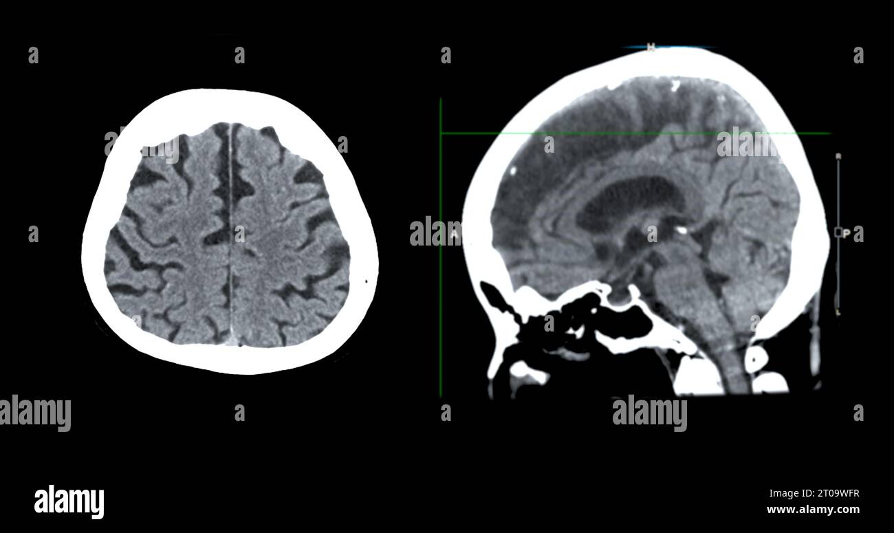 Acquisition CT de la vue sagittale du cerveau pour le diagnostic des tumeurs cérébrales, des maladies cérébrales et des maladies vasculaires. Banque D'Images