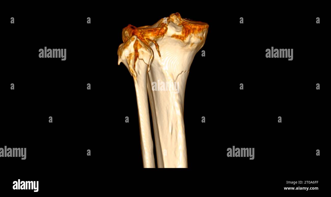 Scanner de l'articulation du genou montrant un rendu 3D de fracture tibia et péroné. Banque D'Images