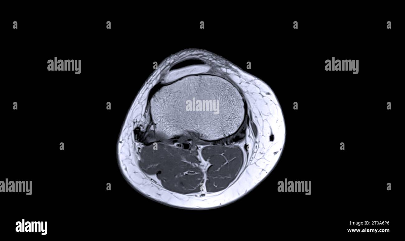 Imagerie par résonance magnétique ou IRM de l'articulation du genou c pour détecter la déchirure ou l'entorse du ligament croisé antérieur (LCA) Banque D'Images
