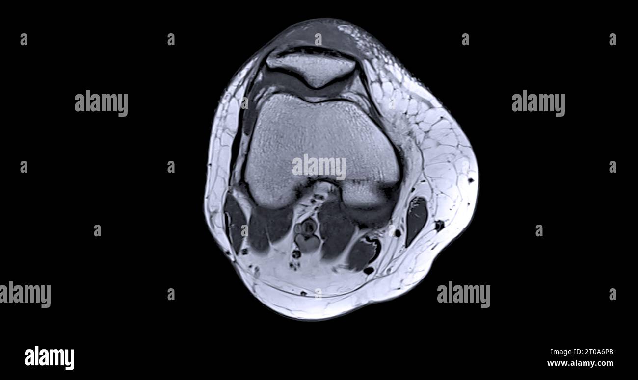 Imagerie par résonance magnétique ou IRM de l'articulation du genou c pour détecter la déchirure ou l'entorse du ligament croisé antérieur (LCA) Banque D'Images