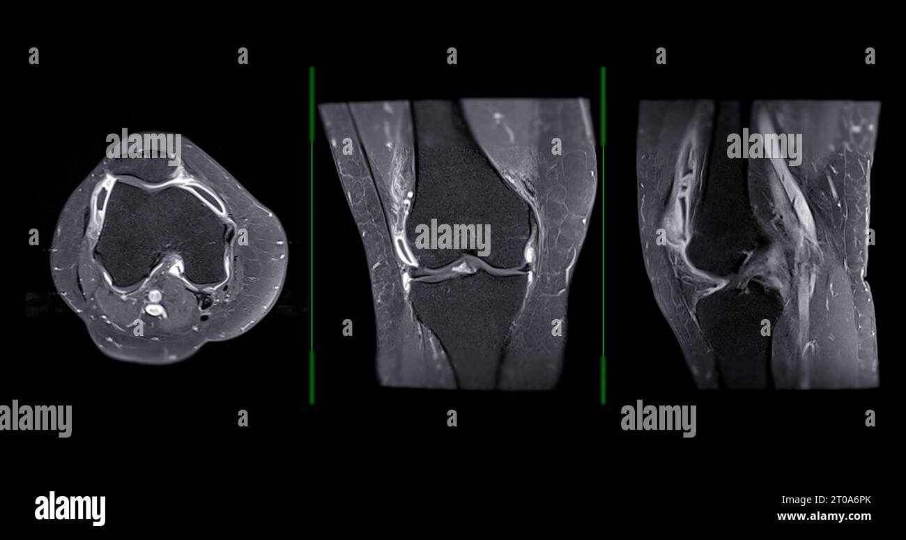 Imagerie par résonance magnétique ou IRM de l'articulation du genou c pour détecter la déchirure ou l'entorse du ligament croisé antérieur (LCA) Banque D'Images
