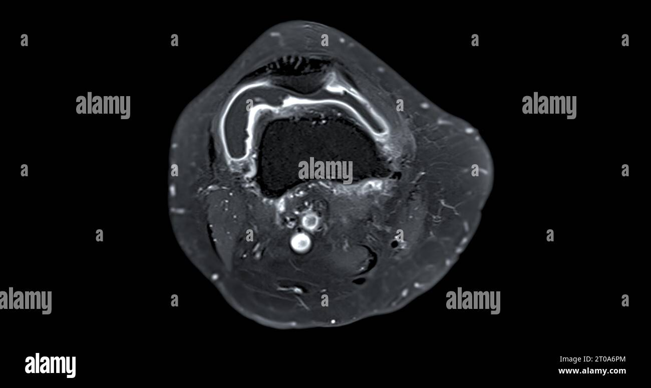 Imagerie par résonance magnétique ou IRM de l'articulation du genou c pour détecter la déchirure ou l'entorse du ligament croisé antérieur (LCA) Banque D'Images