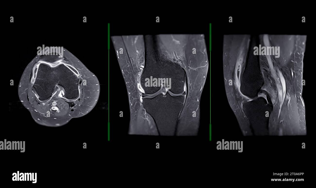 Imagerie par résonance magnétique ou IRM de l'articulation du genou c pour détecter la déchirure ou l'entorse du ligament croisé antérieur (LCA) Banque D'Images
