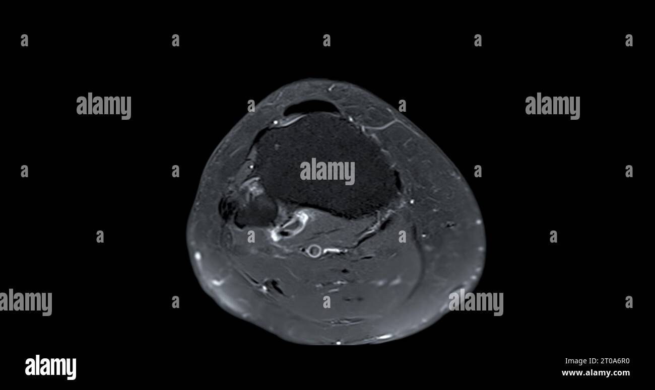 Imagerie par résonance magnétique ou IRM de l'articulation du genou c pour détecter la déchirure ou l'entorse du ligament croisé antérieur (LCA) Banque D'Images