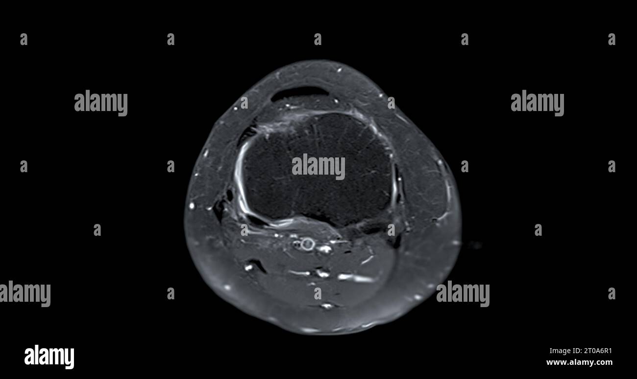 Imagerie par résonance magnétique ou IRM de l'articulation du genou c pour détecter la déchirure ou l'entorse du ligament croisé antérieur (LCA) Banque D'Images
