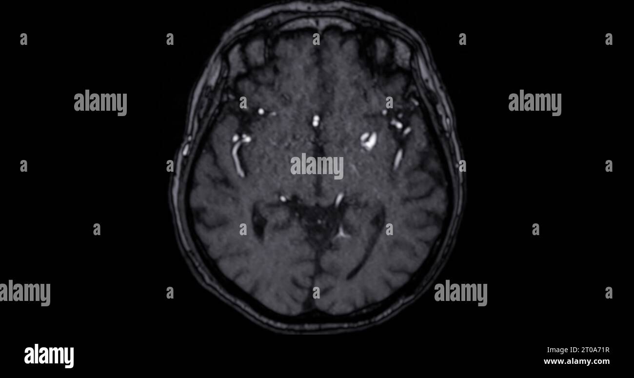 IRM scanner du cerveau pour détecter les maladies du cerveau sush comme maladie d'accident vasculaire cérébral, tumeurs du cerveau et infections. Banque D'Images