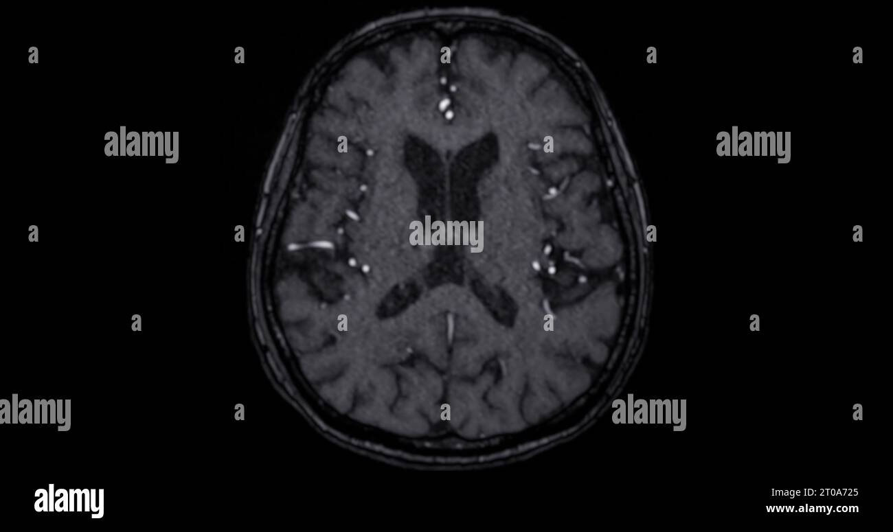 IRM scanner du cerveau pour détecter les maladies du cerveau sush comme maladie d'accident vasculaire cérébral, tumeurs du cerveau et infections. Banque D'Images