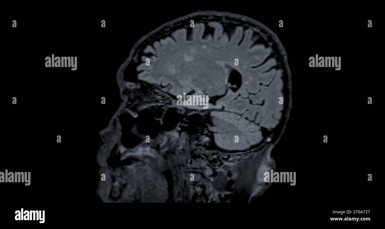 IRM scanner du cerveau pour détecter les maladies du cerveau sush comme maladie d'accident vasculaire cérébral, tumeurs du cerveau et infections. Banque D'Images