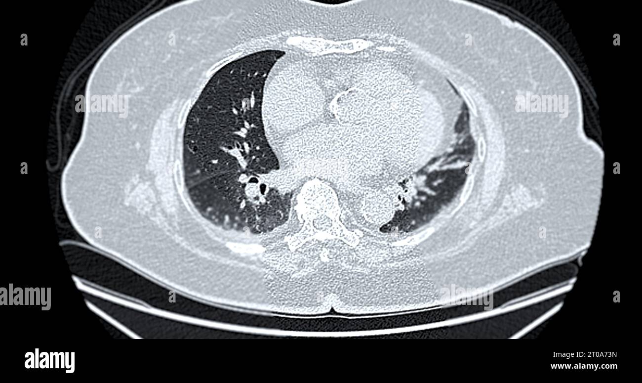 Tomodensitométrie de la vue axiale thorax pour le diagnostic d'embolie pulmonaire (EP), de cancer du poumon et de covid-19. Banque D'Images