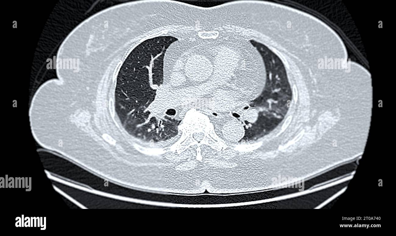 Tomodensitométrie de la vue axiale thorax pour le diagnostic d'embolie pulmonaire (EP), de cancer du poumon et de covid-19. Banque D'Images