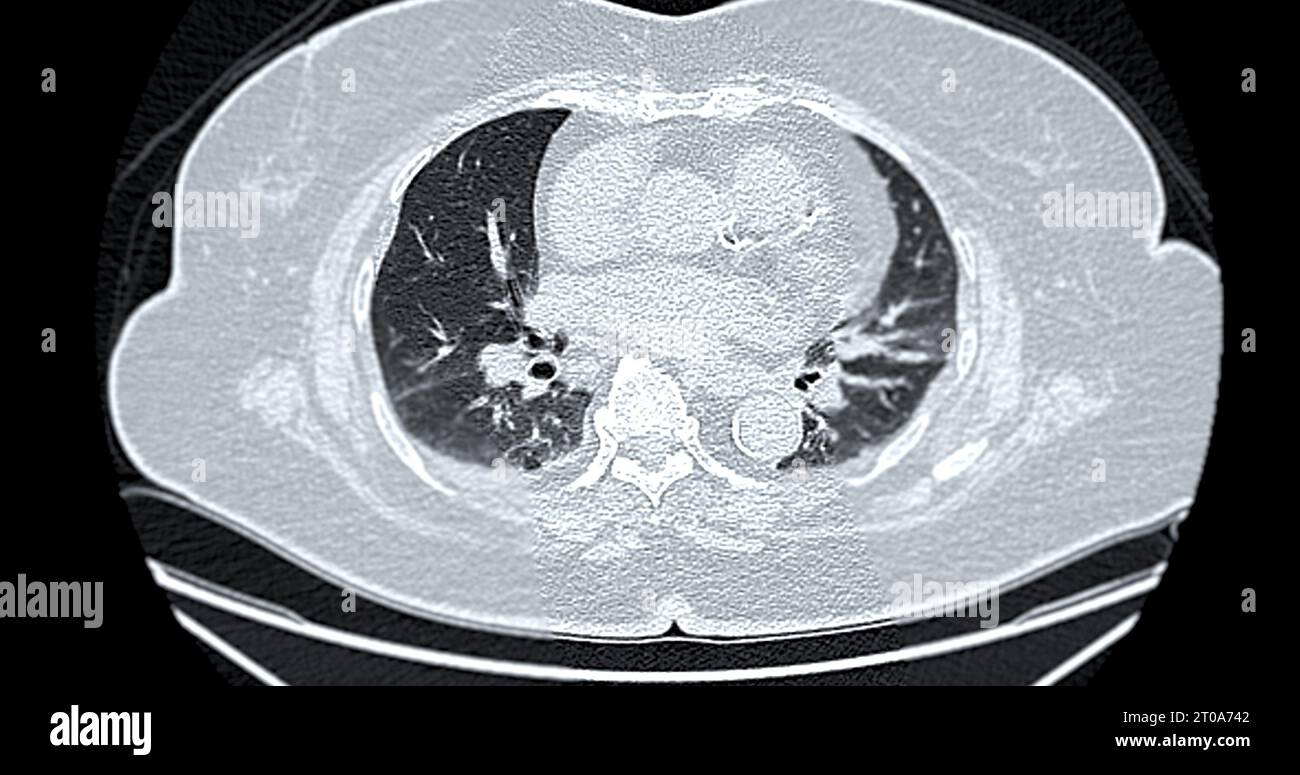 Tomodensitométrie de la vue axiale thorax pour le diagnostic d'embolie pulmonaire (EP), de cancer du poumon et de covid-19. Banque D'Images