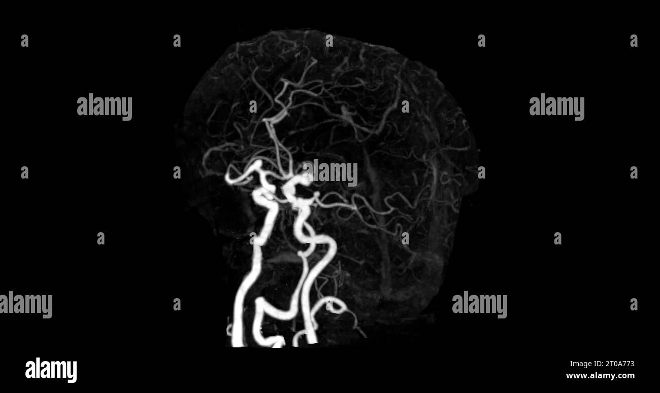 Angiographie cérébrale par tomodensitométrie. concept de technologie médicale. Banque D'Images