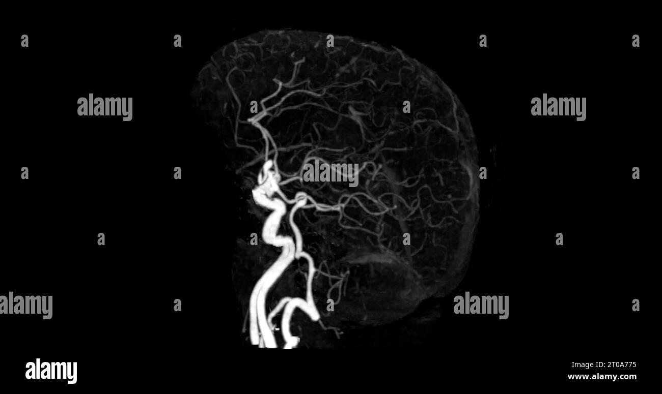 Angiographie cérébrale par tomodensitométrie. concept de technologie médicale. Banque D'Images