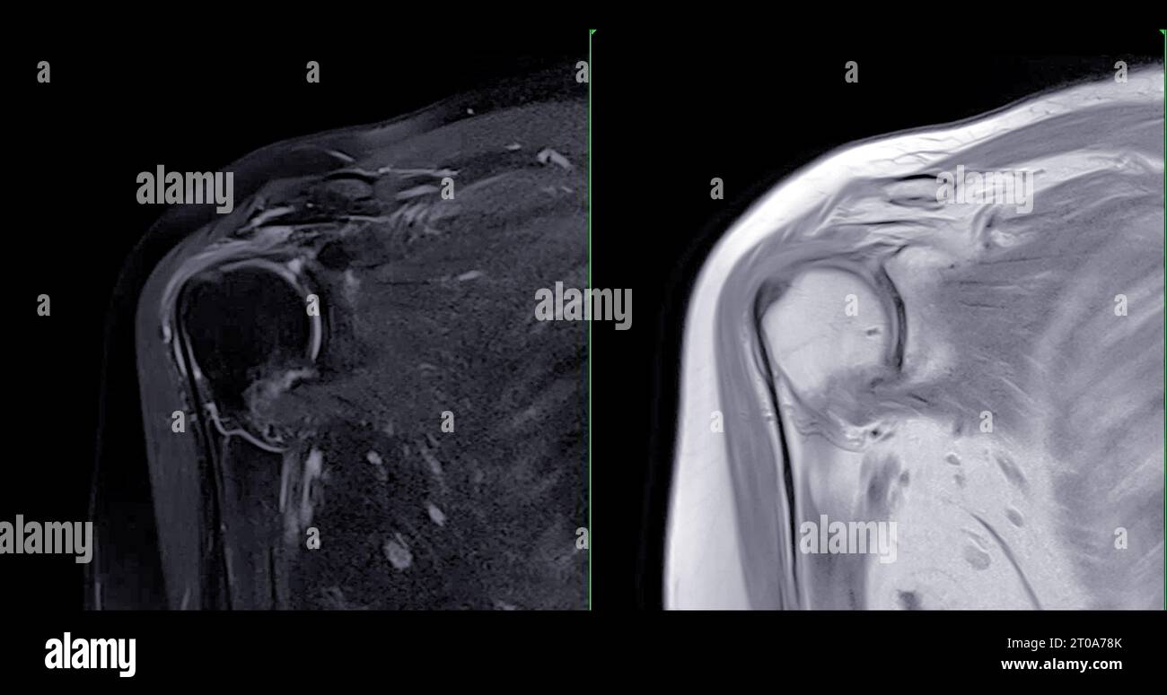 Imagerie par résonance magnétique ou IRM de l'articulation de l'épaule pour le diagnostic de douleur à l'épaule. Banque D'Images