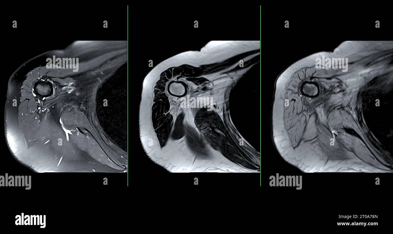 Imagerie par résonance magnétique ou IRM de l'articulation de l'épaule pour le diagnostic de douleur à l'épaule. Banque D'Images