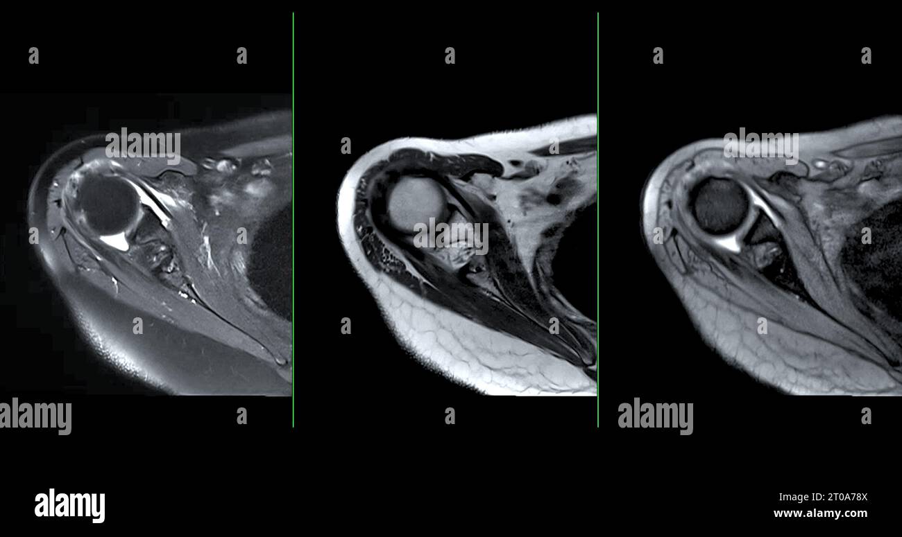 Imagerie par résonance magnétique ou IRM de l'articulation de l'épaule pour le diagnostic de douleur à l'épaule. Banque D'Images