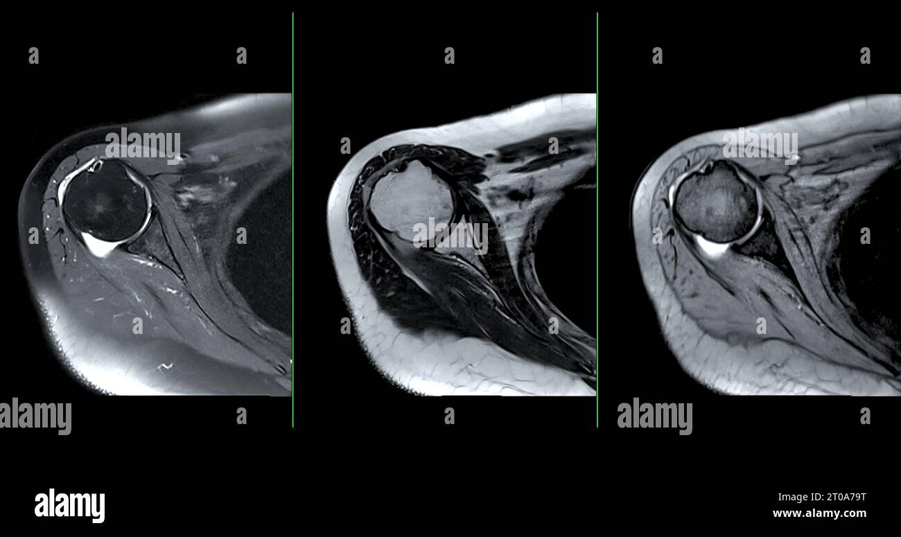 Imagerie par résonance magnétique ou IRM de l'articulation de l'épaule pour le diagnostic de douleur à l'épaule. Banque D'Images